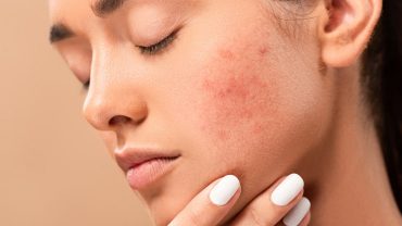 acne skin treatment for you