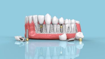 dental implants to replace missing teeth