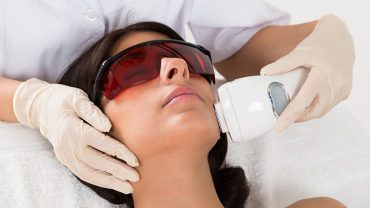 face laser treatment