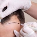 places in turkey to get hair transplant