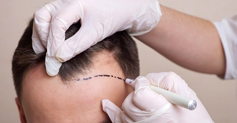 places in turkey to get hair transplant